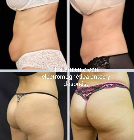 Peluquería Y Estetica Yunia Sauquet Estilistas antes y después de tratamiento corporal